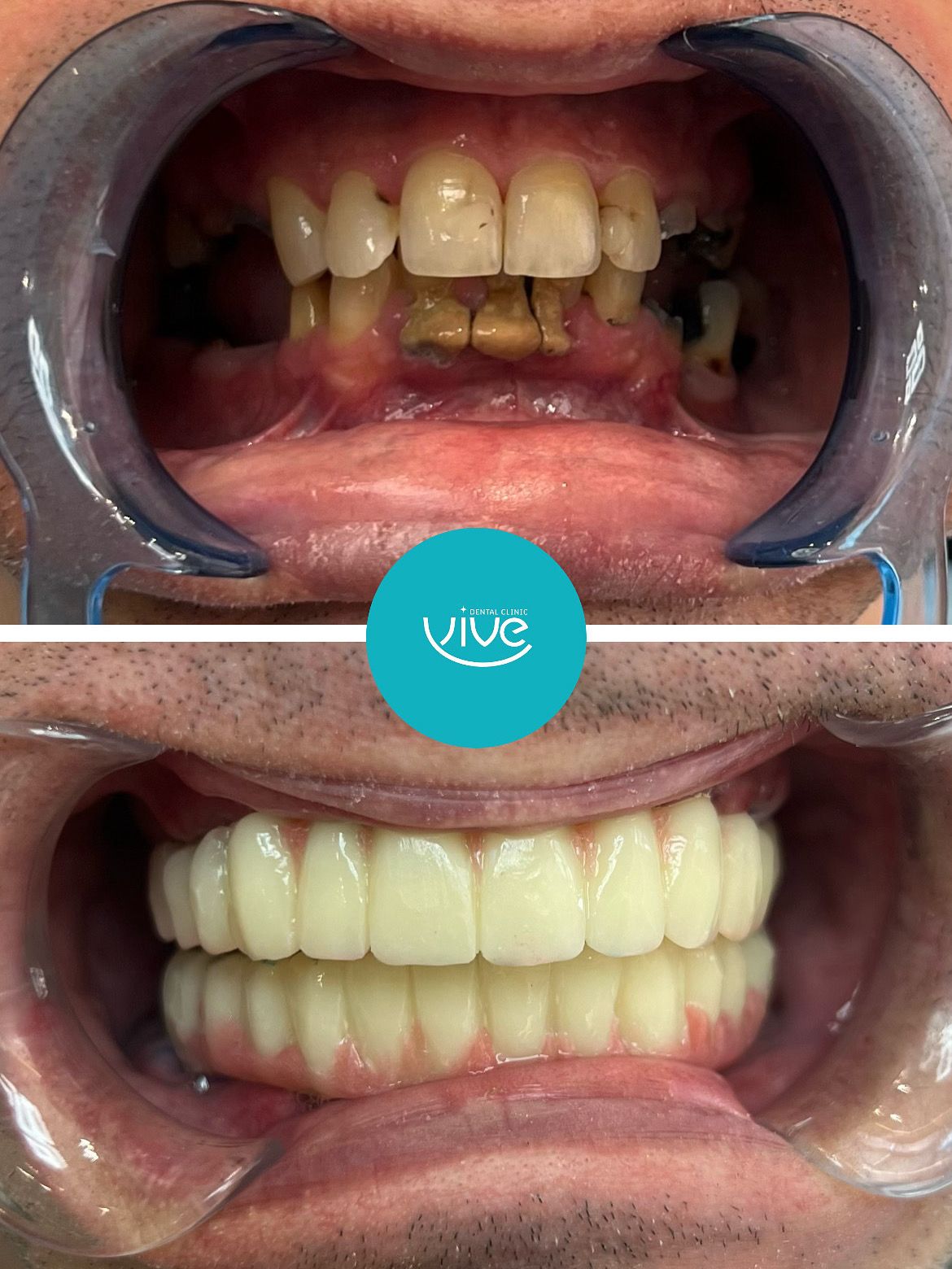 Before After: All-on-4 Dental Implants
