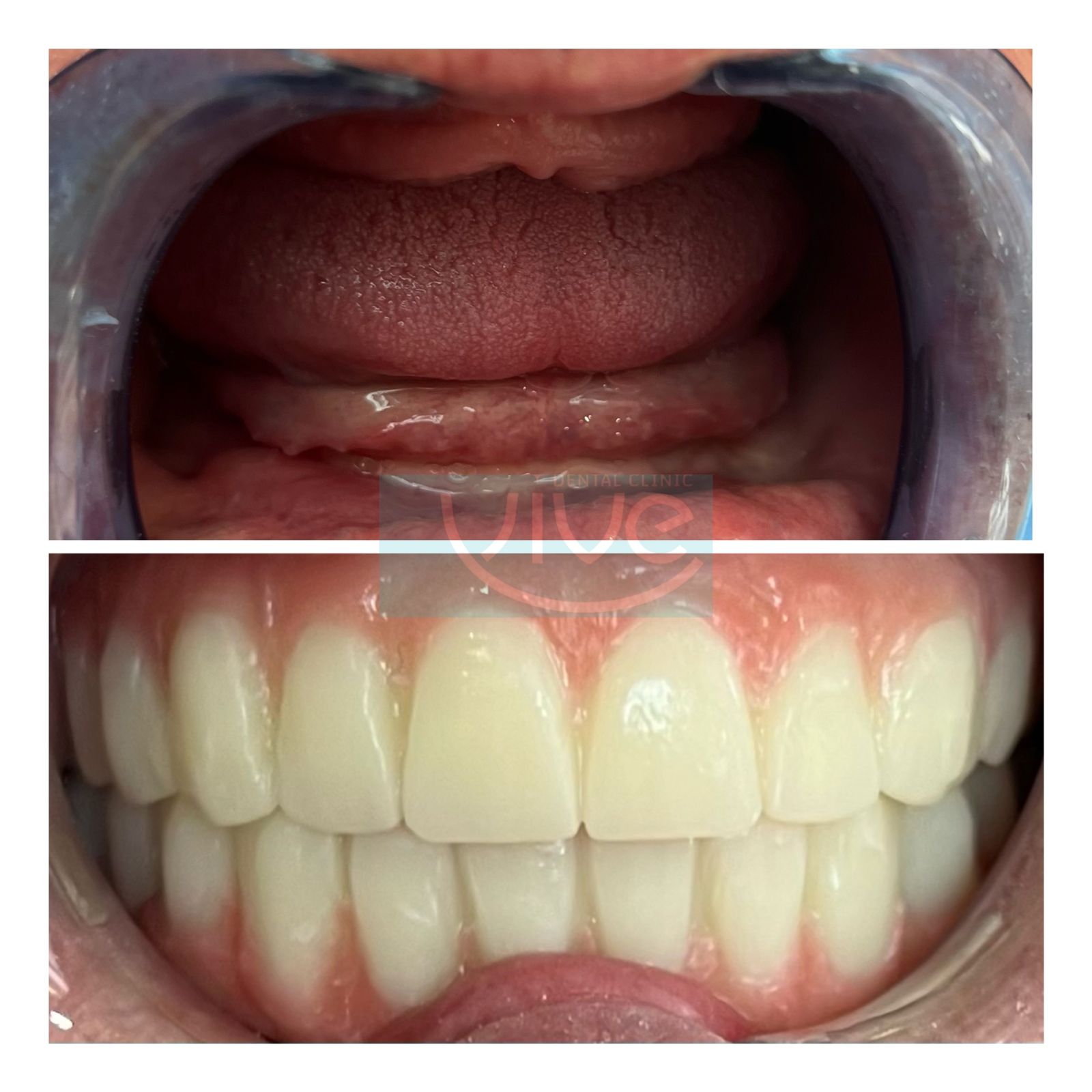 Before After: Zirconia Dental Veneers