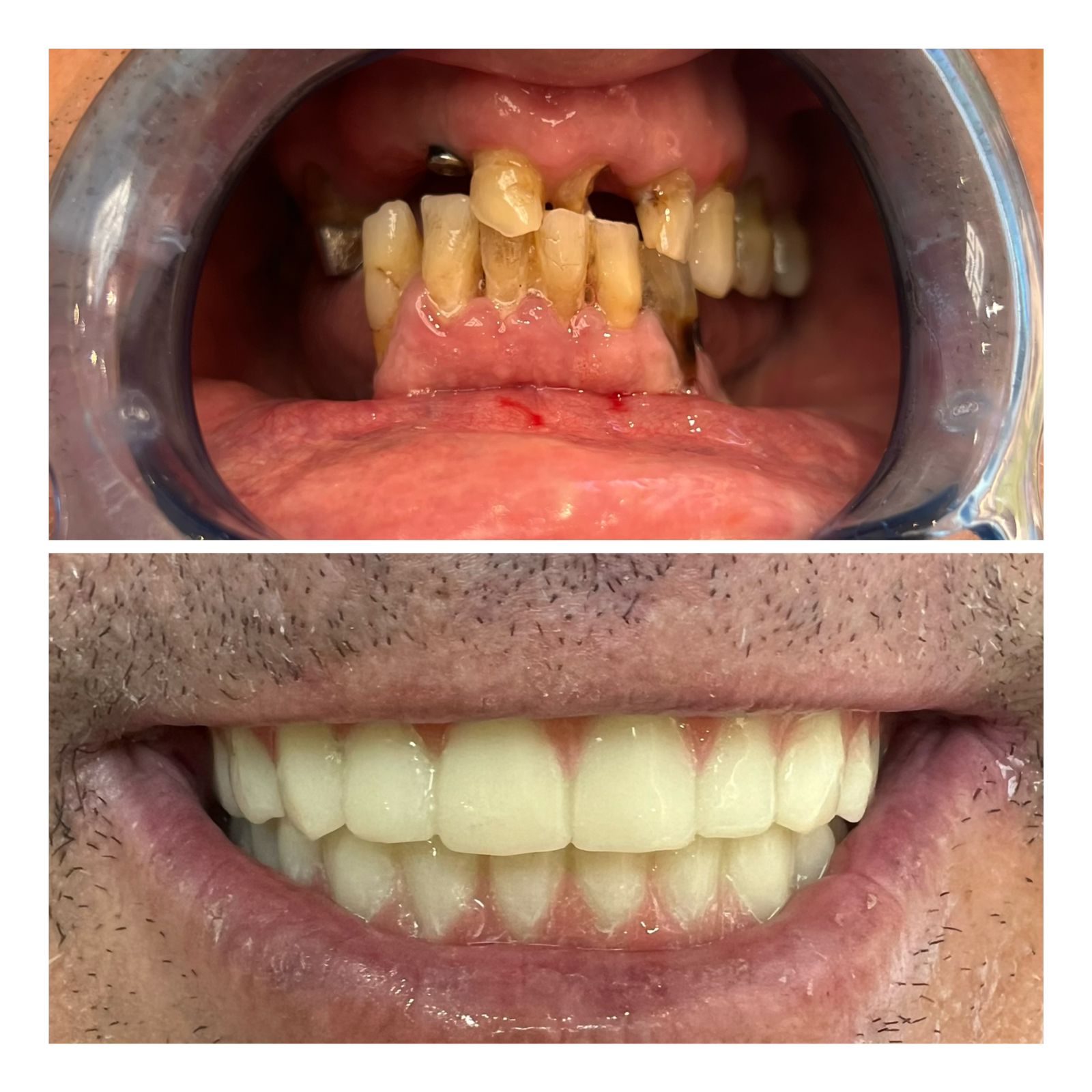 Before After: Implants & Zirconia Crowns