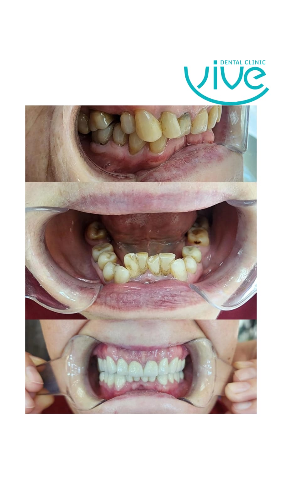 Before After: All-on-6 Dental Implants