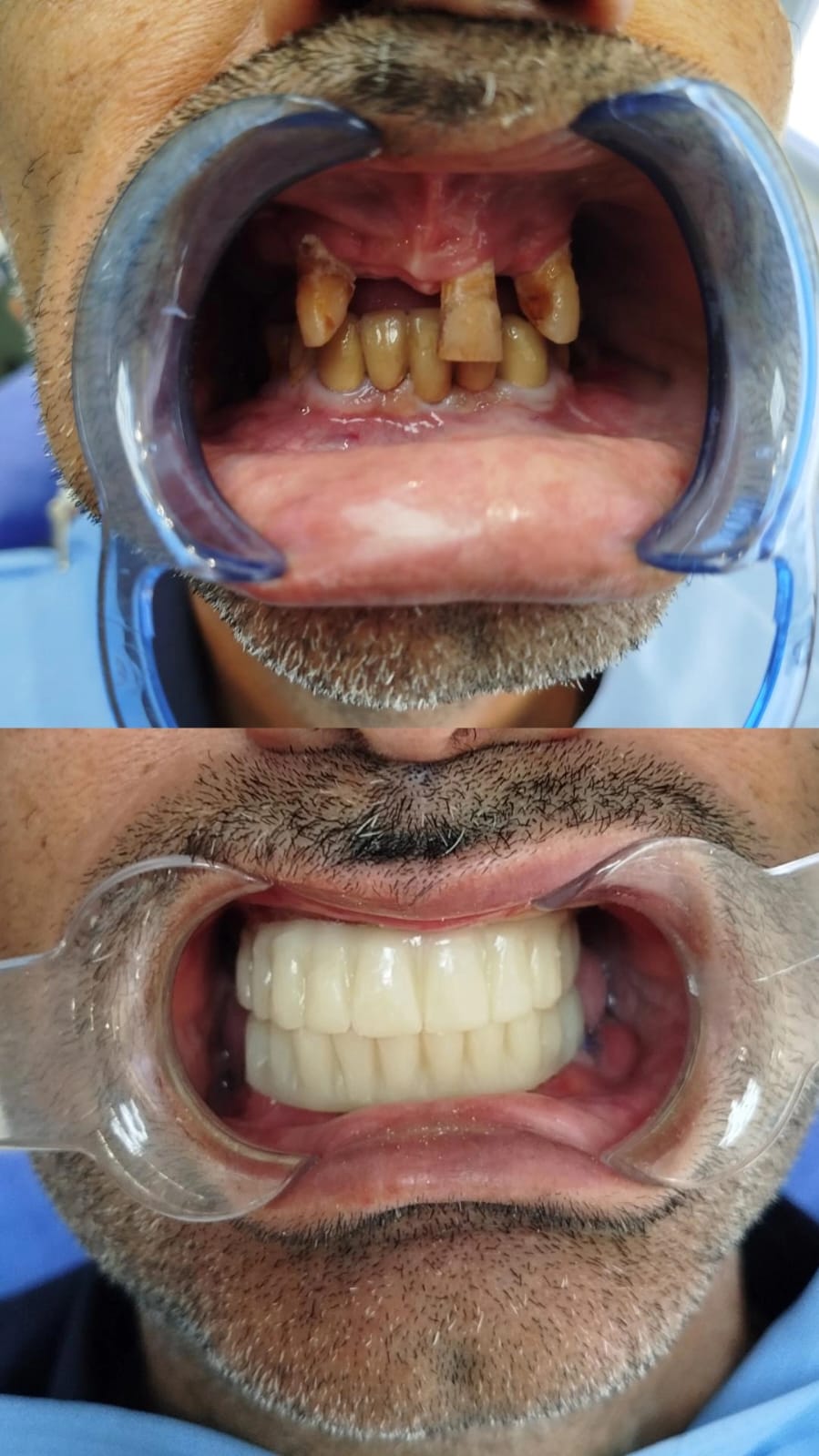 Before After: Fixed Dental Bridges