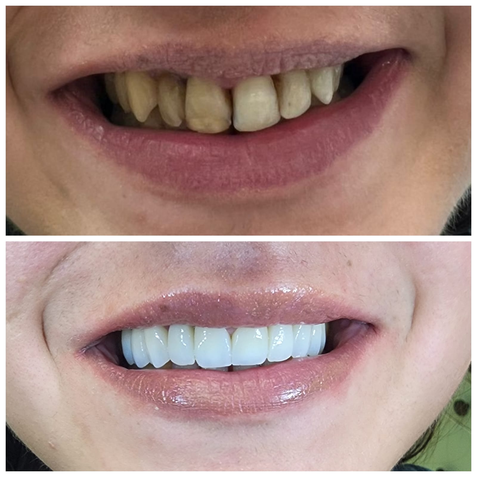 Before After: Aesthetic Dental Crowns