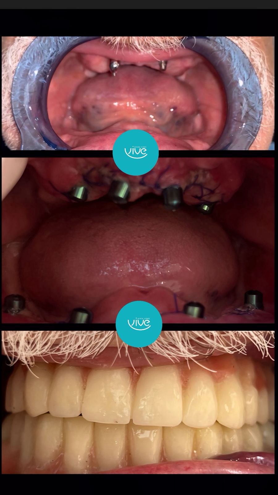 Before After: All-on-4 with Fixed Prosthesis