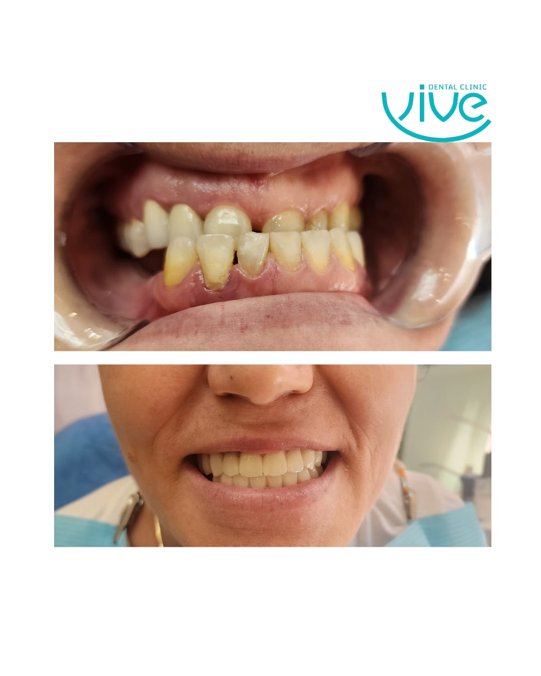 Before After: Veneers & Dental Crowns
