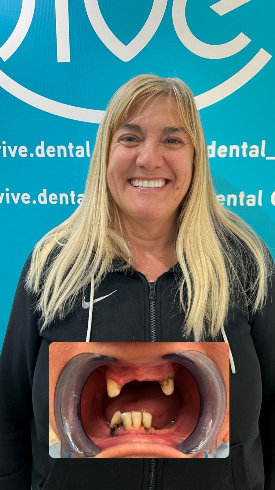 Patient Maria C. after treatment for All-on-4 Implants