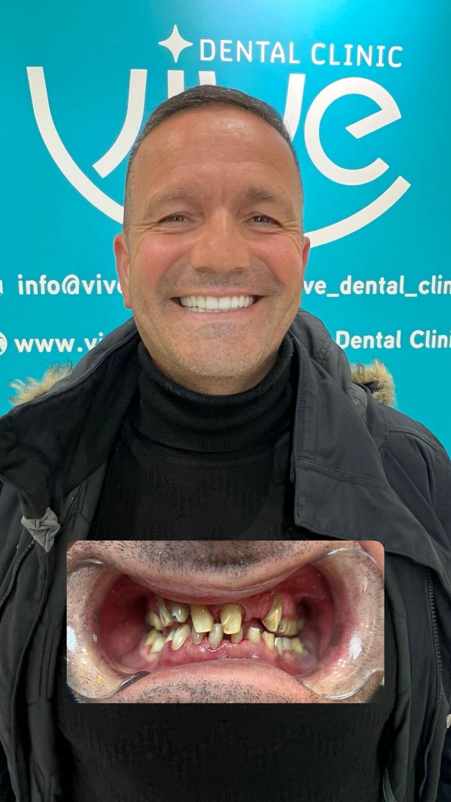 Patient Roberto M. after treatment for Full Reconstruction
