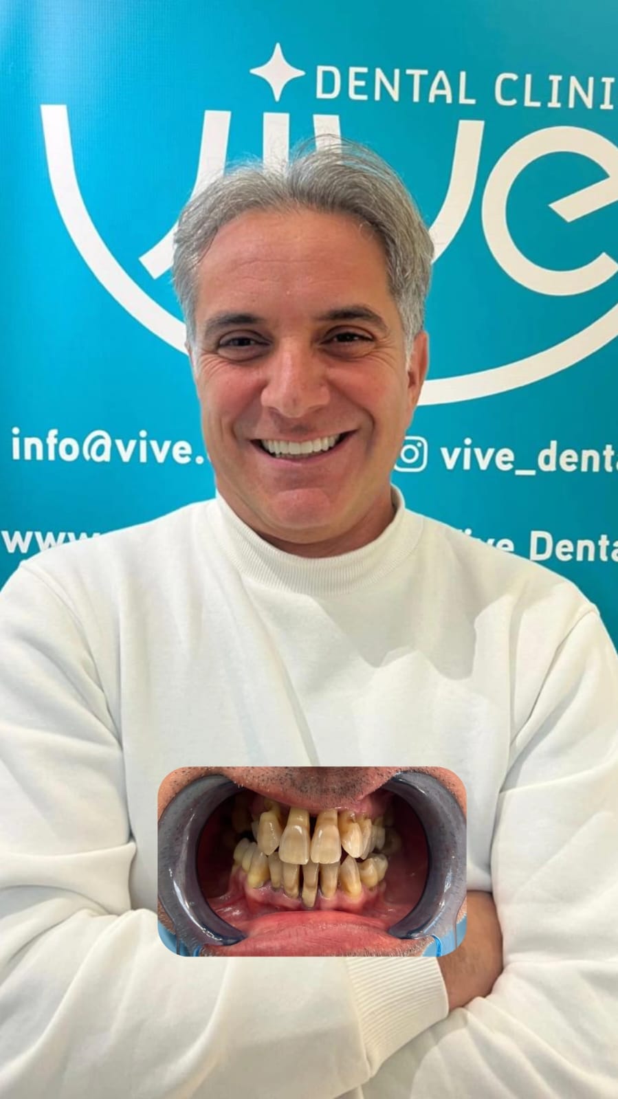 Patient Alessandro P. after treatment for Zirconia Veneers