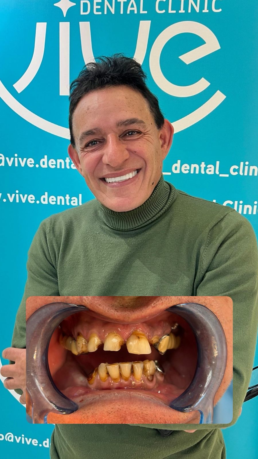 Patient Marco D. after treatment for All-on-6 Implants
